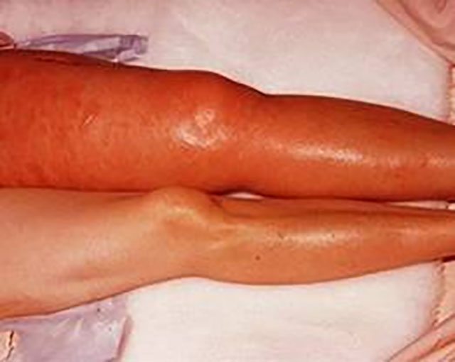 预防静脉血栓栓塞症(图1) 图片1.jpg