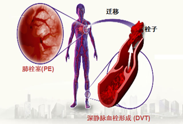 预防静脉血栓栓塞症(图3) 图片3.jpg