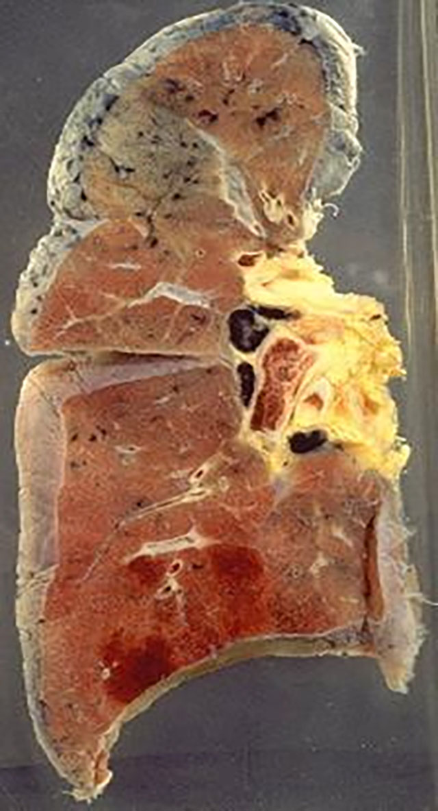 预防静脉血栓栓塞症(图5) 图片5.jpg