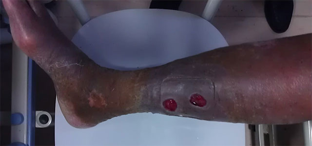 预防静脉血栓栓塞症(图7) 图片7.jpg