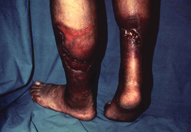 预防静脉血栓栓塞症(图6) 图片6.jpg