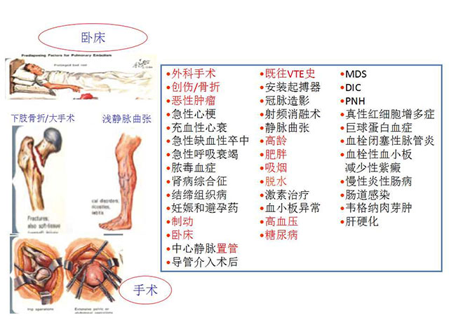 预防静脉血栓栓塞症(图8) 图片8.jpg