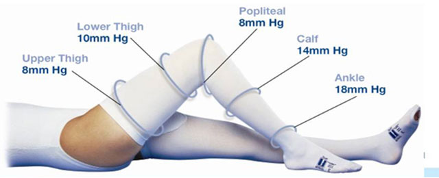预防静脉血栓栓塞症(图12) 图片12.jpg
