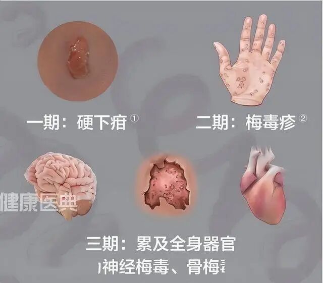 4岁女孩全身长满红疹子,确诊梅毒……(图3) 痛3.jpg