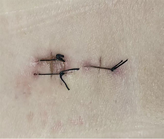 “走50米就……”泸州孃孃痛了5年(图2) 2.jpg