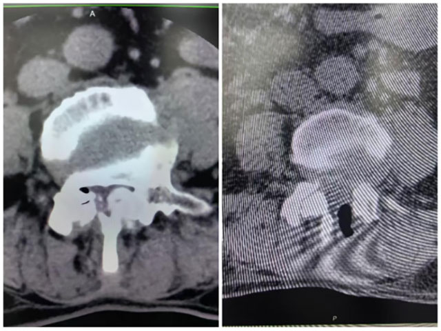 “走50米就……”泸州孃孃痛了5年(图3) 3.jpg