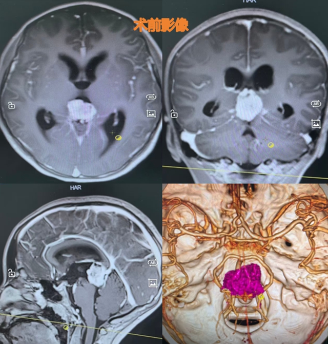 13岁的“抗瘤少女”,从绝望深渊到重返校园......(图1) 1.jpg