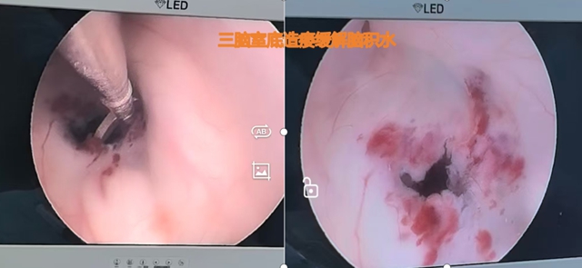 13岁的“抗瘤少女”,从绝望深渊到重返校园......(图2) 2.jpg