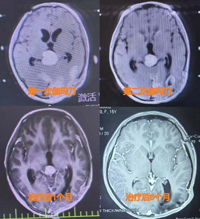 13岁的“抗瘤少女”,从绝望深渊到重返校园......(图3) 3.jpg