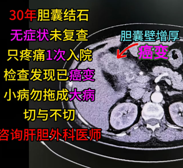 男子胆囊结石30年无症状,第1次发作就已成癌王(图2) 2.jpg