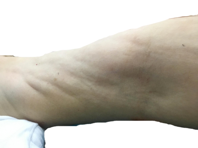 孃孃手术后抬不起手,是……(图1) 手1.jpg