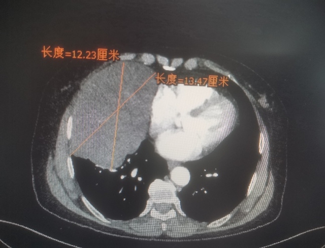 胸痛心累、咳嗽咯痰……泸州两人接连查出罕见肿瘤(图2) 百2.jpg