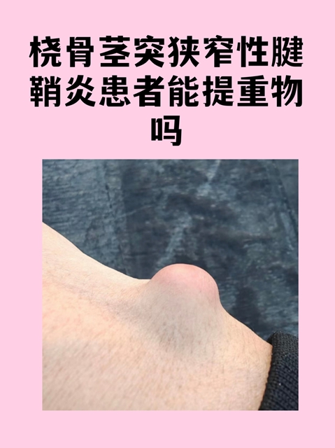 手腕手指疼痛、弹响、掰不直,还……(图2) 手2.jpg