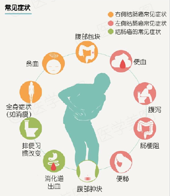 大便次数变多,一查竟是肠癌!这些症状需警惕(图3) 便3.jpg