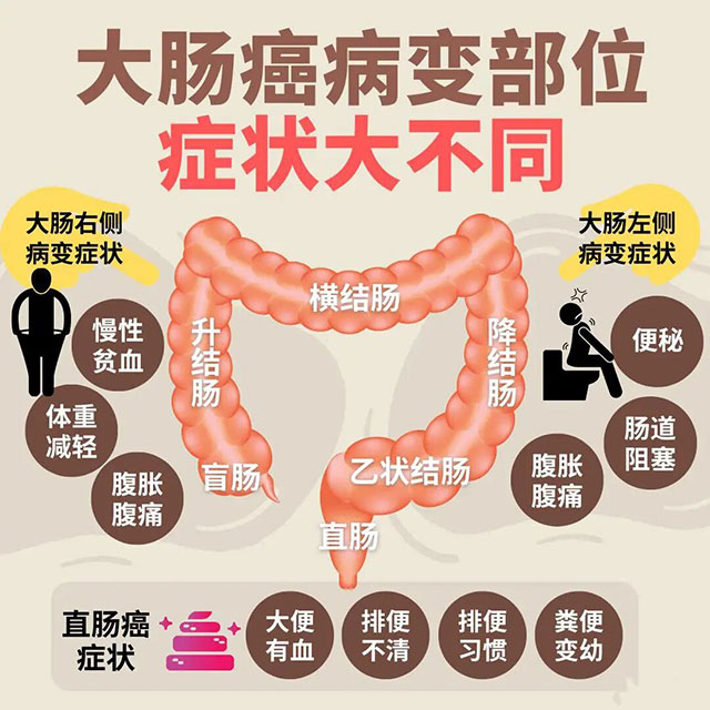 毫无症状,男子查出肠癌!医生:别拖,这样的大便需警惕(图4) 4.jpg