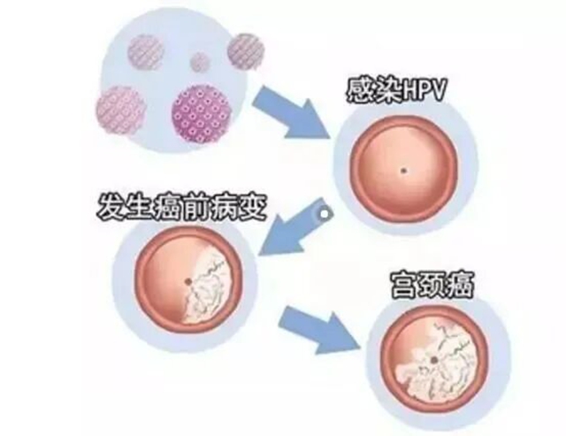 00后、05后女子外阴长“菜花”,确诊宫颈癌前病变!感染HPV后到底有多可怕(图2) 5.jpg