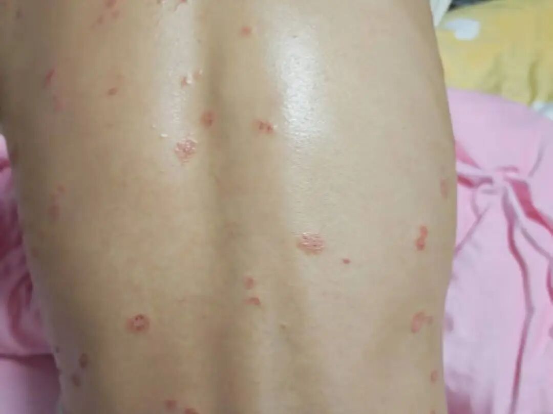 岐黄攻坚| 怪病?13岁男孩全身红斑,瘙痒难耐(图1) 宝1.jpg