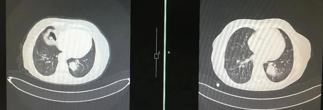 【西南医大中医院•关注】疫情之下！肺癌晚期再次多处转移(图7)