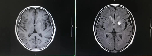 【西南医大中医院•关注】疫情之下！肺癌晚期再次多处转移(图8)