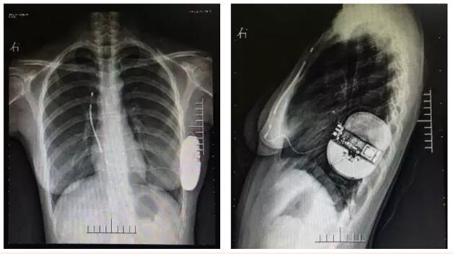 川南地区首例全皮下植入式心律转复除颤器植入术成功完成(图3)