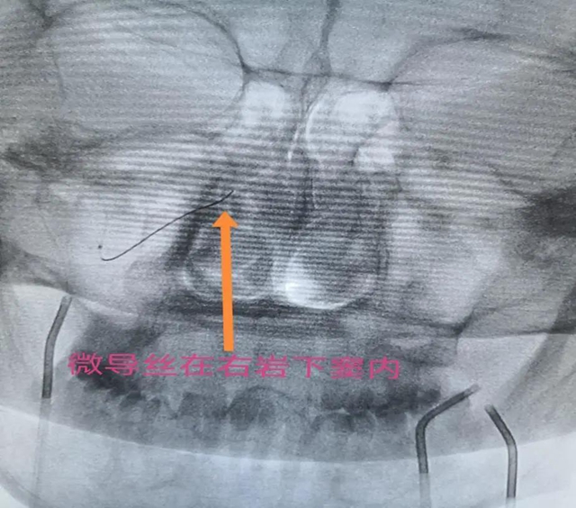 跻身国内先进水平!西南医大附院库欣病诊断技术获突破(图6) 跻身国内先进水平!西南医大附院库欣病诊断技术获突破(图6)