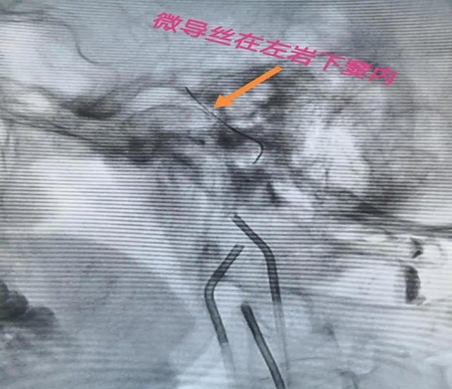 跻身国内先进水平!西南医大附院库欣病诊断技术获突破(图5) 跻身国内先进水平!西南医大附院库欣病诊断技术获突破(图5)