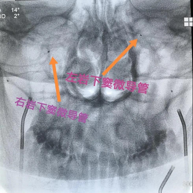 跻身国内先进水平!西南医大附院库欣病诊断技术获突破(图4) 跻身国内先进水平!西南医大附院库欣病诊断技术获突破(图4)