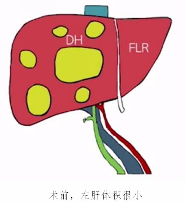 泸州首例ALPPS！泸州市中医医院根治晚期肝癌有全新突破(图3)