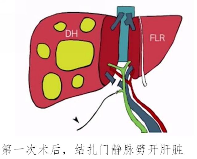 泸州首例ALPPS！泸州市中医医院根治晚期肝癌有全新突破(图4)