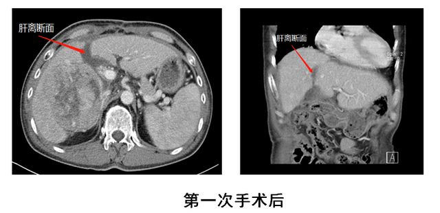 泸州首例ALPPS！泸州市中医医院根治晚期肝癌有全新突破(图6)