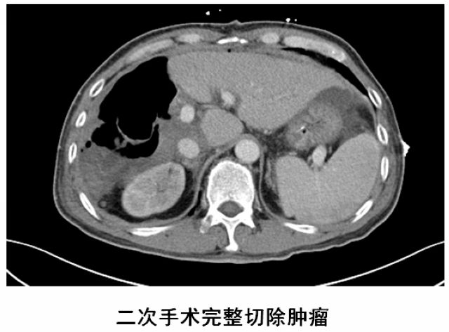 泸州首例ALPPS！泸州市中医医院根治晚期肝癌有全新突破(图7)