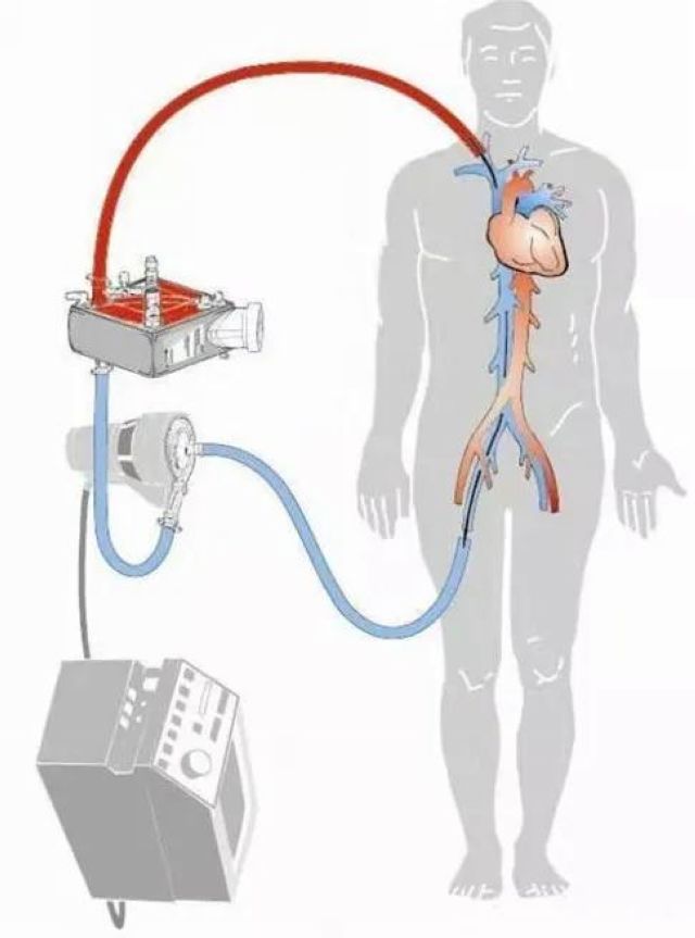 首例!救命的硬核武器—ECMO技术在西南医大附院成功开展(图1) 首例!救命的硬核武器—ECMO技术在西南医大附院成功开展(图1)