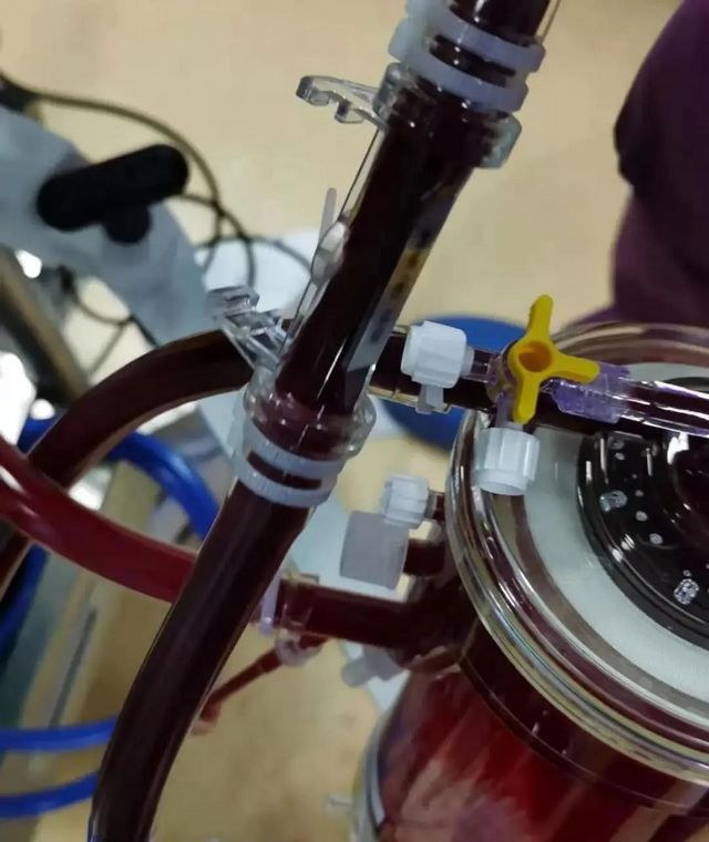 首例!救命的硬核武器—ECMO技术在西南医大附院成功开展(图5) 首例!救命的硬核武器—ECMO技术在西南医大附院成功开展(图5)