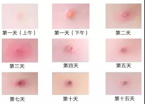 川南学生家长速看：当前已进入水痘高发期！(图3)