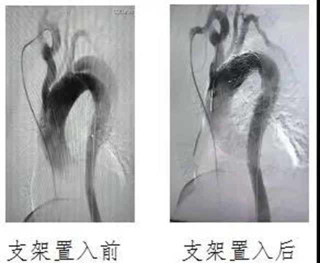 泸州市人民医院首次独立成功完成复杂胸腹主动脉夹层血管腔内修复术(图4)