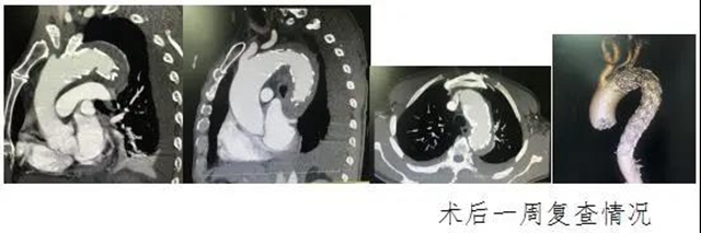 泸州市人民医院首次独立成功完成复杂胸腹主动脉夹层血管腔内修复术(图3)