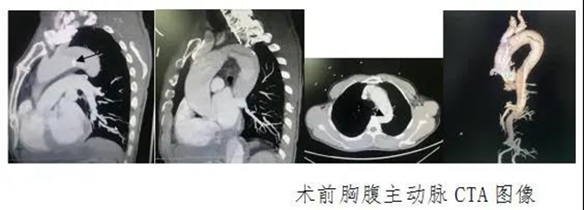 泸州市人民医院首次独立成功完成复杂胸腹主动脉夹层血管腔内修复术(图2)