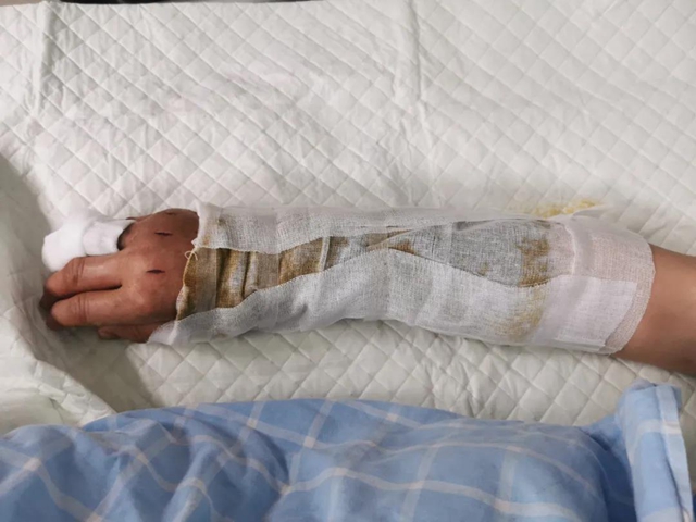 毒蛇提前出关?泸州2人被咬伤住院……(图4) 毒蛇提前出关?泸州2人被咬伤住院……(图4)