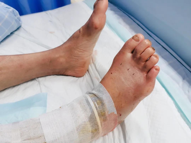 毒蛇提前出关?泸州2人被咬伤住院……(图5) 毒蛇提前出关?泸州2人被咬伤住院……(图5)