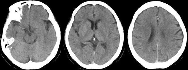七旬婆婆突发脑梗死，深夜抢救1小时完全恢复！(图2)