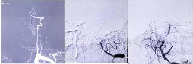 七旬婆婆突发脑梗死，深夜抢救1小时完全恢复！(图3)