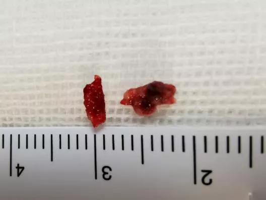 七旬婆婆突发脑梗死，深夜抢救1小时完全恢复！(图4)