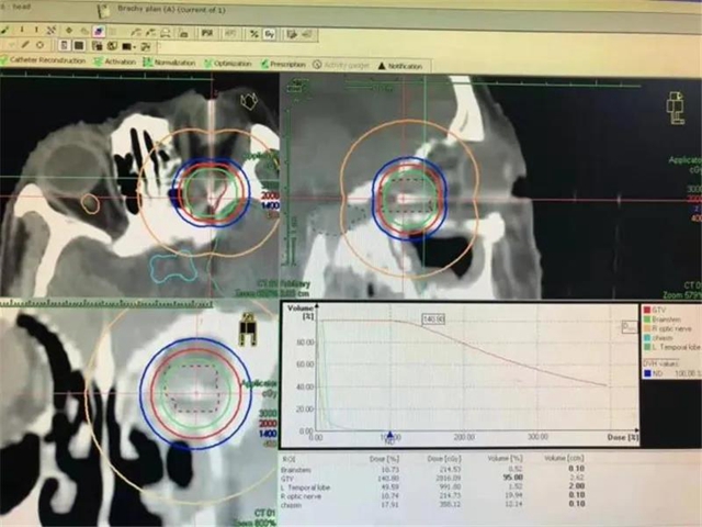 肿瘤难治？你还不知道西南医大附竟有这项对付众多肿瘤的领先技术！(图15)