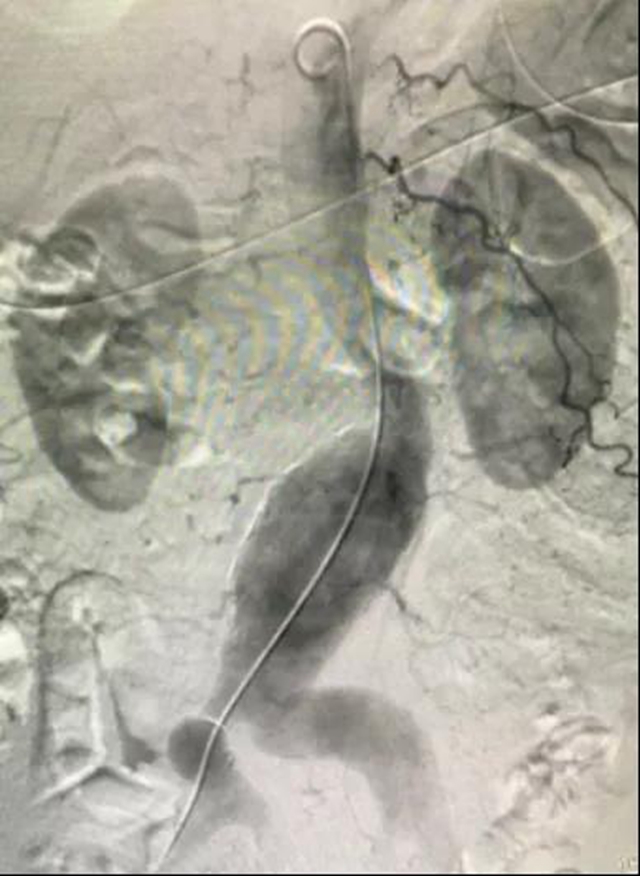 泸州市人民医院独立成功完成首例腹主动脉瘤血管腔内修复术(图3)