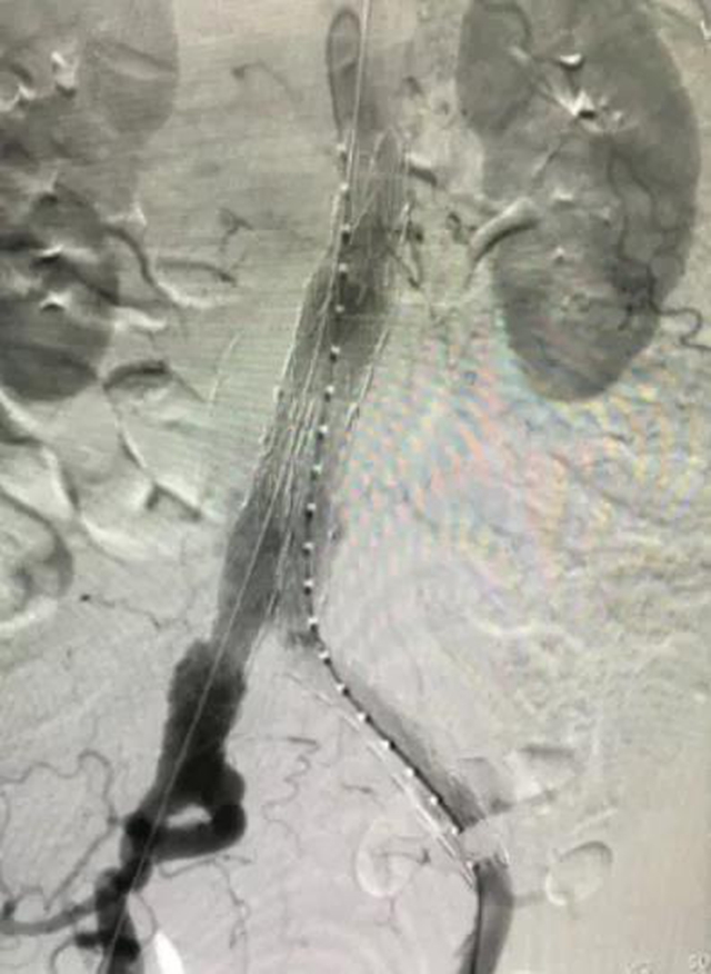 泸州市人民医院独立成功完成首例腹主动脉瘤血管腔内修复术(图4)