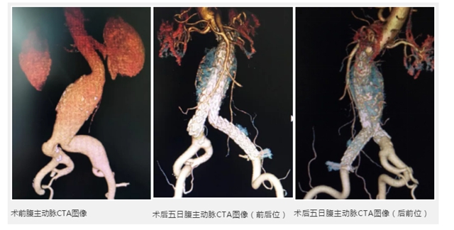 泸州市人民医院独立成功完成首例腹主动脉瘤血管腔内修复术(图5)