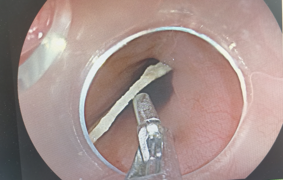 泸州9岁女孩误吞鸭骨，险些……(图3)