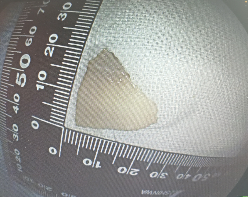 泸州9岁女孩误吞鸭骨，险些……(图4)