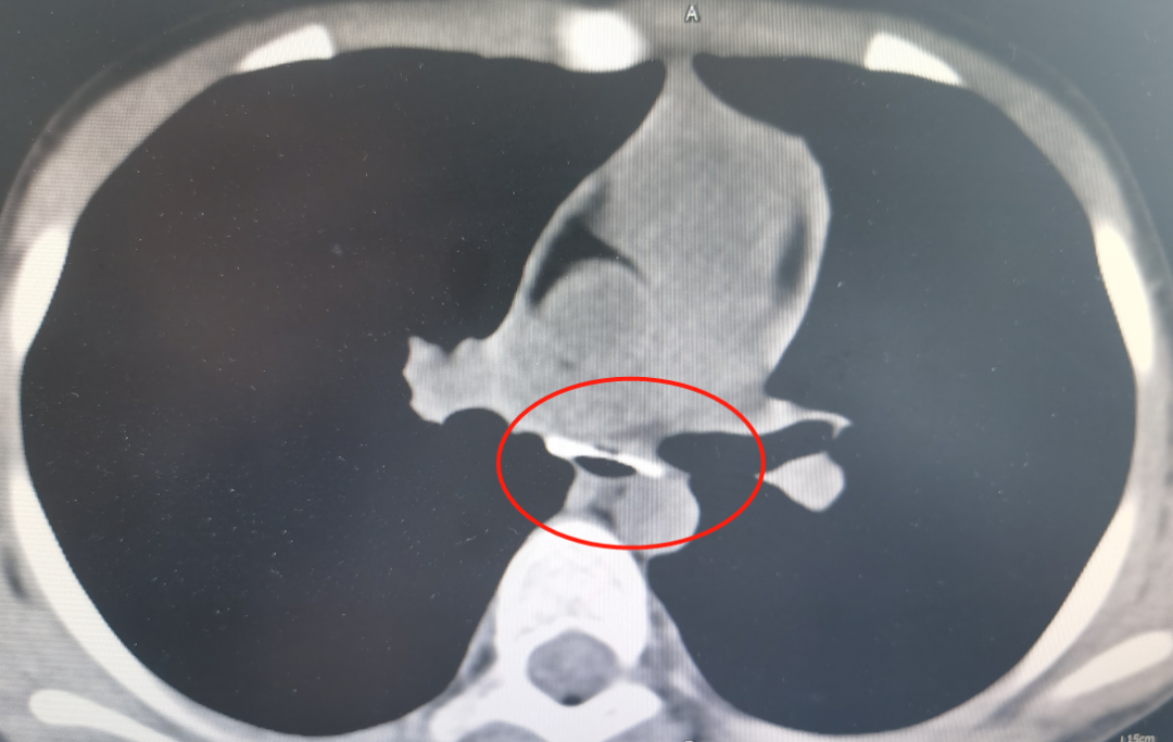 泸州9岁女孩误吞鸭骨，险些……(图2)
