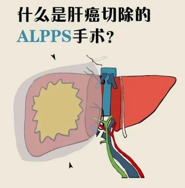 【扩散】肝癌中晚期患者，可以根治啦？(图4)